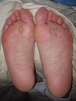 warts on feet