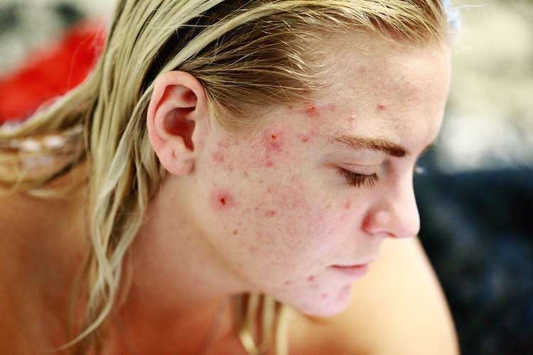 Acne on face