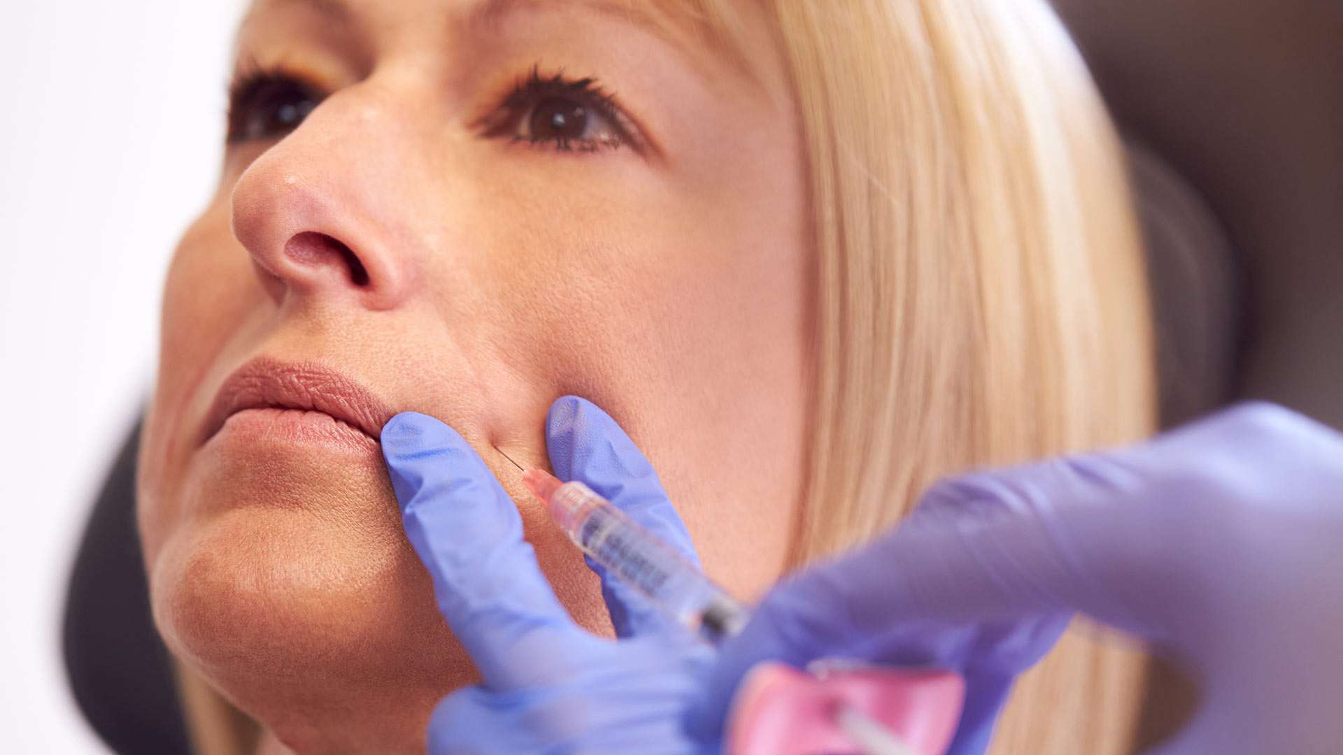 Minimize Nasolabial Folds