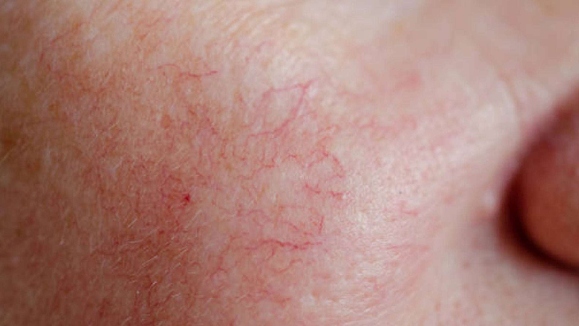 8 Reasons to Consider IPL Photofacial Treatment 4 Eliminate Capillaries and Visible Veins