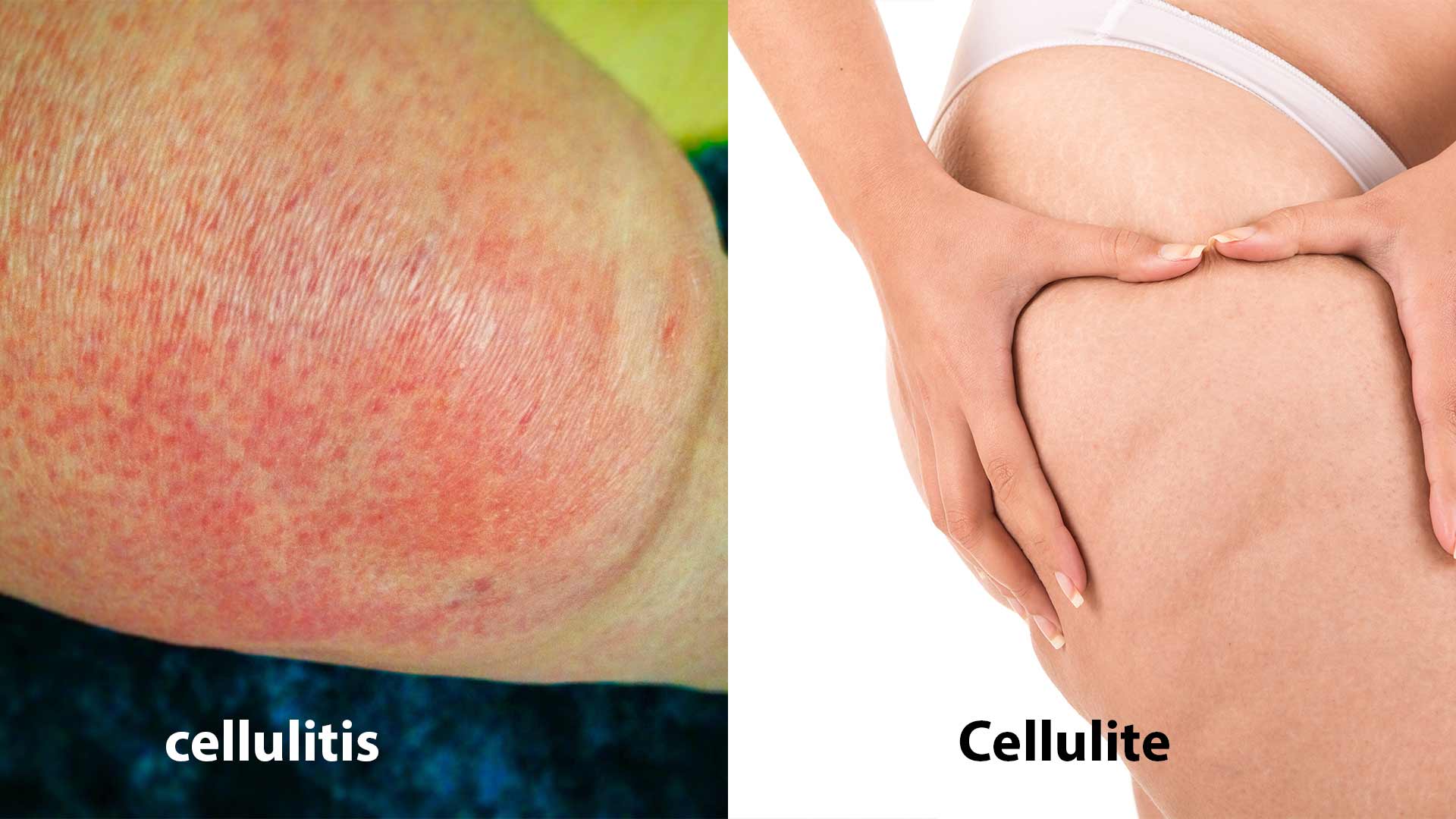 Cellulitis and Cellulite