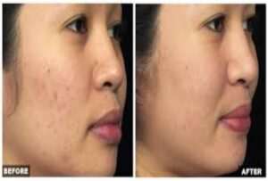 Side-by-side comparison of a womans face before and after skincare treatment. The before image shows acne scars and redness, while the after image displays smoother and clearer skin.