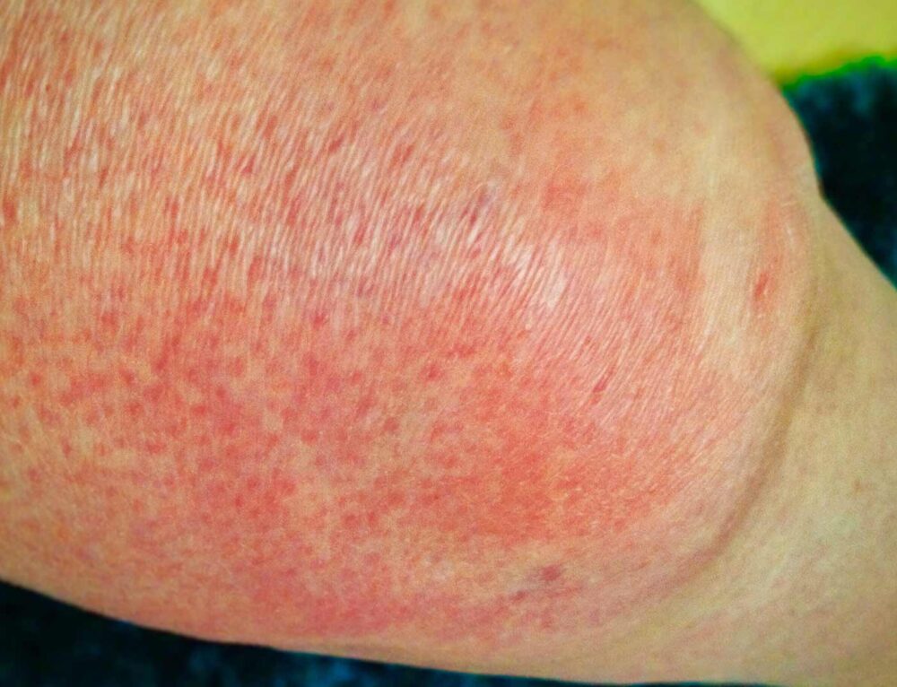 Weird Skin Conditions That Occurs As You Age