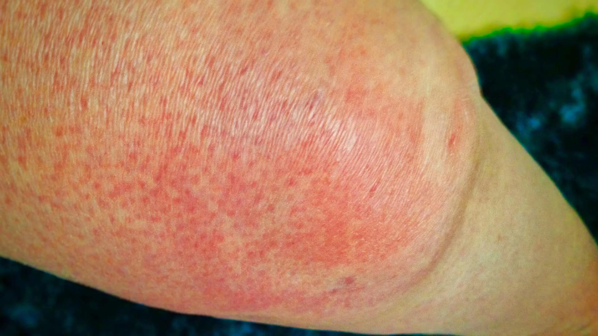 Cellulitis